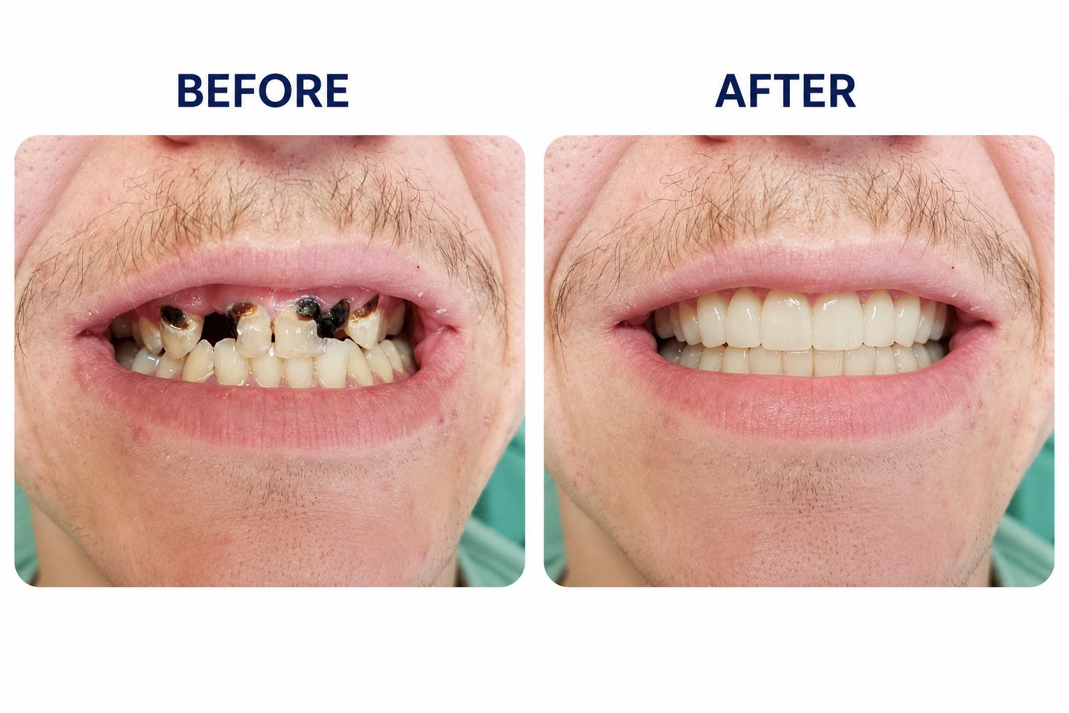 Before and after dental restoration example by Perfect 32 Dental Care