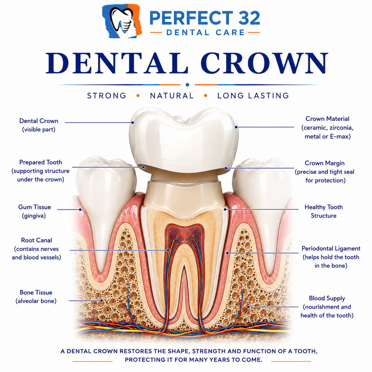 Dental Crown - Perfect 32 Dental Care