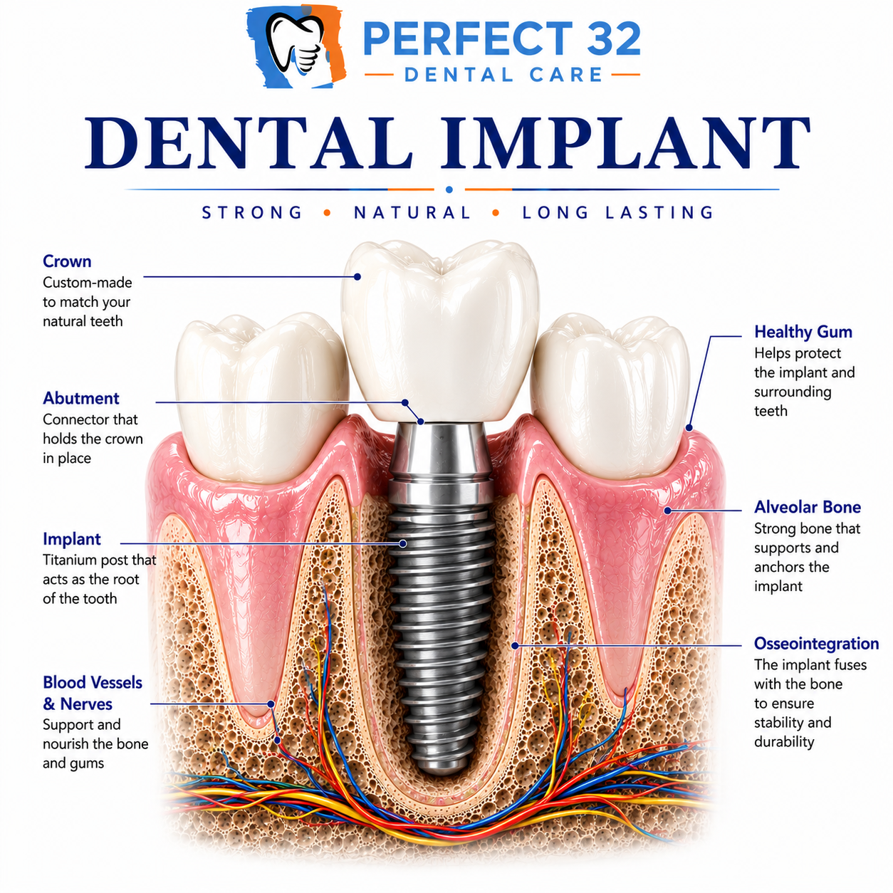 Dental Implants - Perfect 32 Dental Care