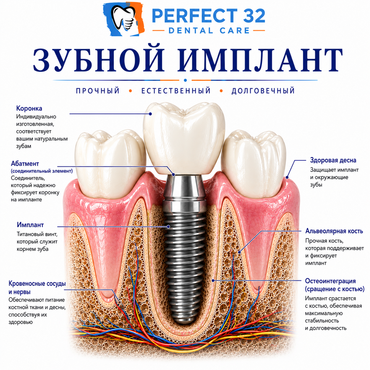 Зубные импланты - Perfect 32 Dental Care